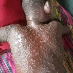 Uvira : 478 cas de MPOX enregistrés dans la zone de santé d’Uvira , parmi les quels 3 décès .