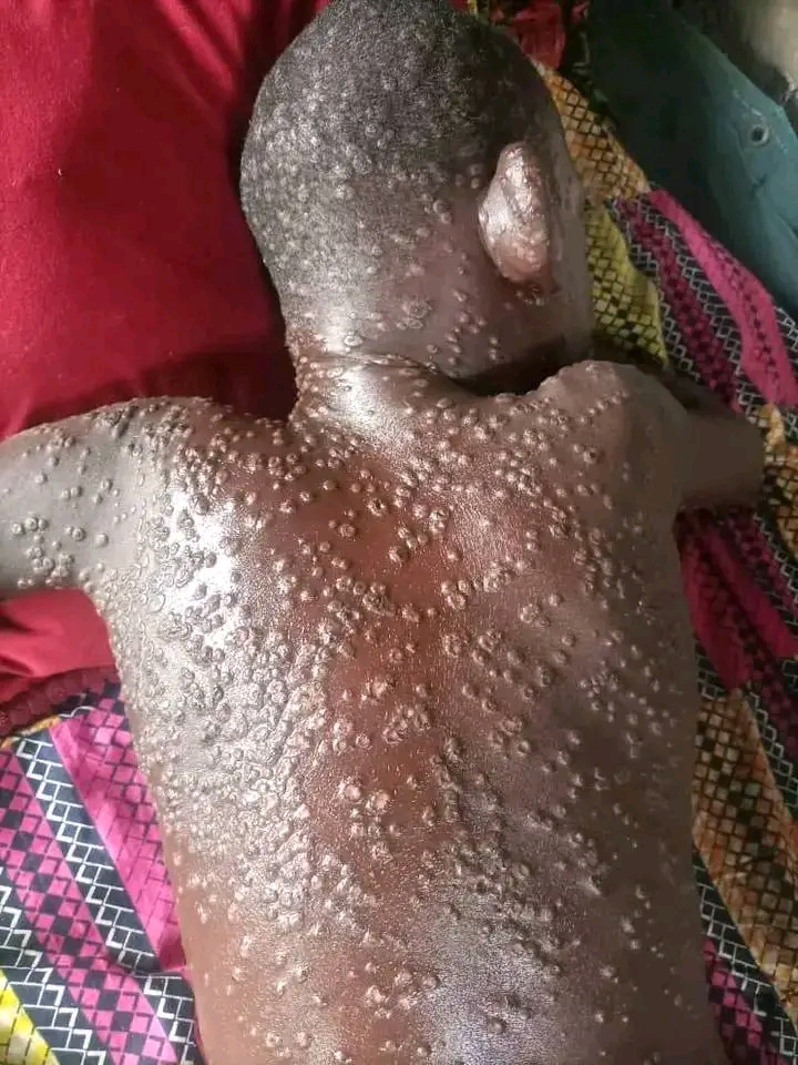 Uvira : 478 cas de MPOX enregistrés dans la zone de santé d’Uvira , parmi les quels 3 décès .