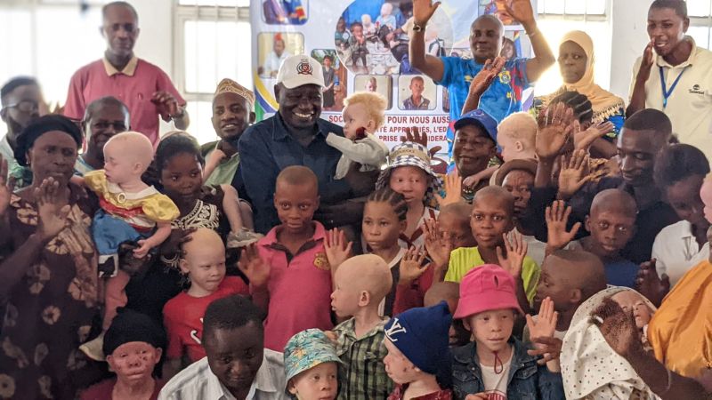 Uvira : la SOCINE plaide pour la scolarisation et la prise en charge des enfants albinos