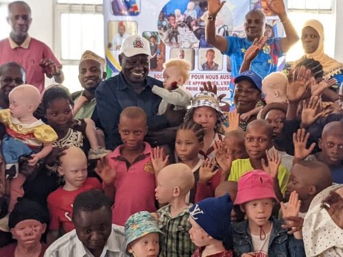 Uvira : la SOCINE plaide pour la scolarisation et la prise en charge des enfants albinos